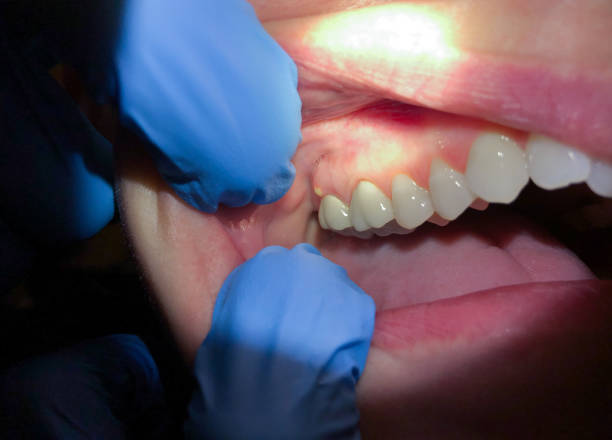 Best Emergency Treatment for Oral Infections in Burton, SC