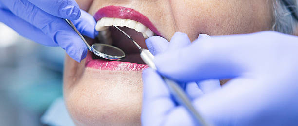 Best Emergency Wisdom Tooth Extraction in Burton, SC