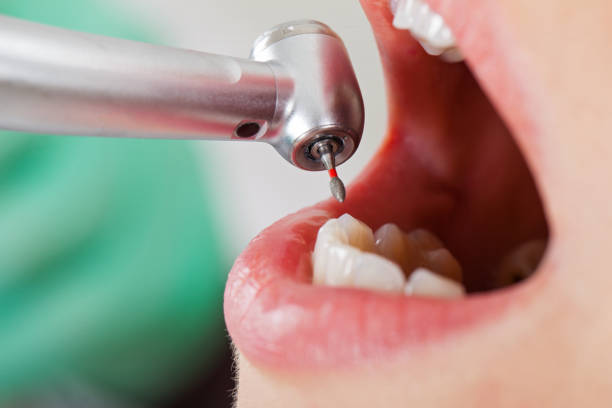 Best Emergency Root Canal Therapy in Burton, SC